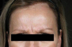Case 1 - before (top) and after (bottom) BOTOX to treat frown lines Before